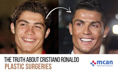 Did Ronaldo Have Plastic Surgery? Exploring the Rumors and Realities